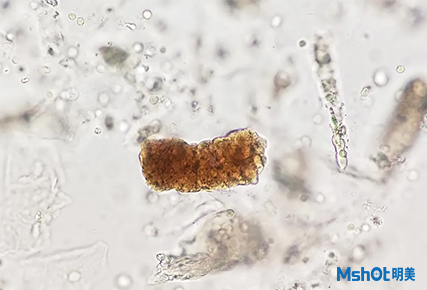 尿沉渣顯微鏡檢查：一個重要的實驗室診斷工具