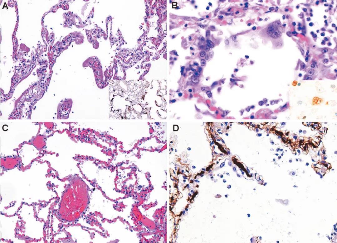 圖2:鏡下肺部表現(xiàn) 圖2:鏡下肺部表現(xiàn)