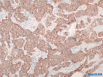 免疫組化 病理圖